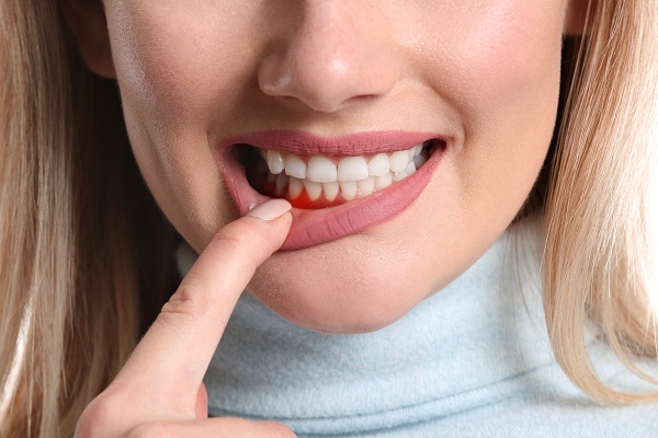 Woman pointing at inflamed gum.